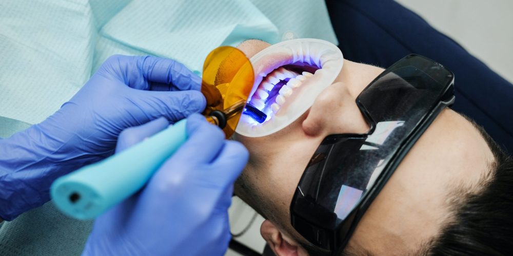 Sbiancamento dentale: in cosa consiste?